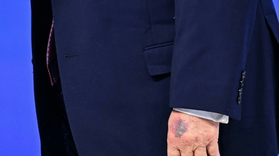 Trump atribui hematomas em sua m&atilde;o a pancada em mesa 
