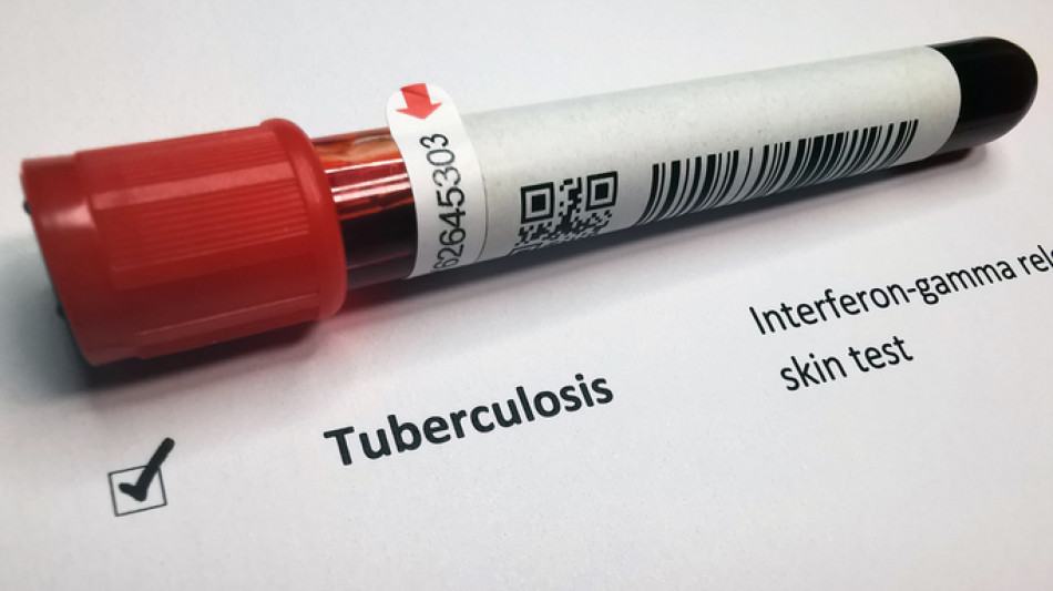 In Europa 200.000 casi di tubercolosi in un anno, 1 su 4 da ceppi resistenti